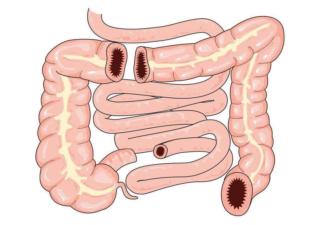 肠息肉的症状是什么